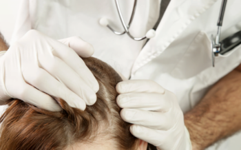 Mastering Scalp Psoriasis: Tips for Beautiful Hair and Confidence